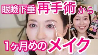 【50代眼瞼下垂】経過報告&ダウンタイムのメイク法【再手術】