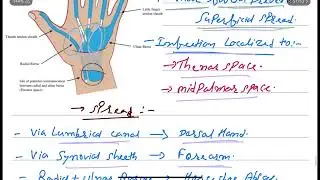 Palmar Abscess &ndash; Deep Space Infection of the Hand