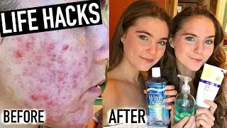 15 Life Hacks To CLEAR ACNE | NinaAndRanda