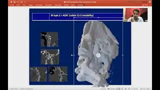 Surgical Management of Atlanto Axial Dislocation and Basilar Invagination -CVJ Anomaly