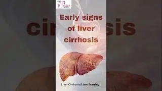 Early signs of liver cirrhosis @MMChomoeopathy