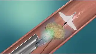[Microport Urocare] Stone Entrapment and Extraction Device for URS