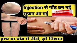 Cure Dark Patches? Using Thrombophob for Bruising & Varicose Vein Relief (Must Know!)