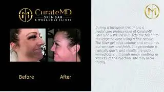 Juvederm in Chandler, AZ - CurateMD Skin Bar