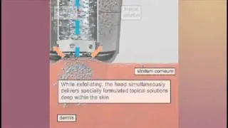 Silk Peel