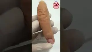 Precision. Comfort. Confidence.Custom finger prosthesis by QPROST