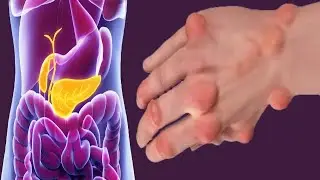 Rheumatoid Arthritis And Diabetes: What Is The Link?