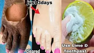 Colgate toothpaste for Leg whitening   Lemon and colgate 1
