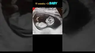 Baby 11 weken +3 | echo #baby #echografie #zwanger