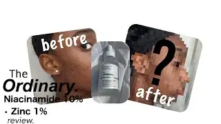 Обзор средства The Ordinary Niacinamide 10% Zinc 1% (1 месяц) | для чувствительной комбинированной кожи