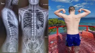 How long does it take to recover from spinal fusion surgery&hellip;