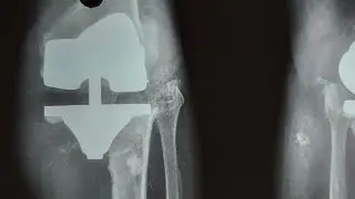 TKA X-Ray : What To See And How To Interpret