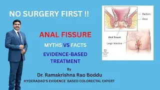 Fissure  In Ano | Myths vs Facts | Evidence Based Treatment | Dr Rama Krishna Rao Boddu