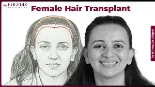 Female Hair Transplant: An Inspiring Hairline Restoration Journey at Eugenix