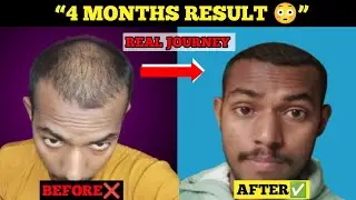 Hair Regrowth Journey | 4 Months Result 😳 | Before After Hair Growth