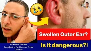 Cauliflower Ear Explained: Causes, Symptoms & Real Treatment Options | ProHealthConsults