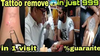 Cheapest Price Main Tattoo Remove In One Visit only for 999 Rupees 😊 Guarantee 100%