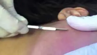 Dermaplaning