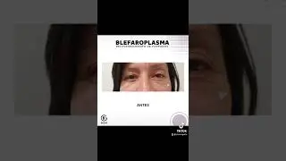 BLEFAROPLASMA| Dra Kelly Gulfo Cl&iacute;nica Gulfo