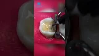 Remake the poor filling - part 2