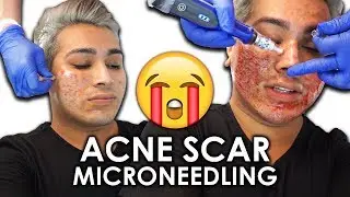 FIXING MY ACNE SCARS (TEXTURED SKIN) | $400 Vampire Facial Treatment