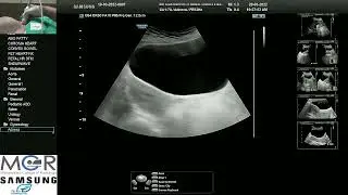 TAS pelvis