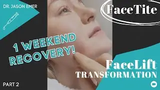 FaceTite: Facelift Transformation with Only a Weekend's Recovery! Results - Part 2