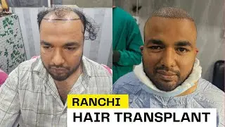 Revilo Hair Transplant Ranchi / Banglore To Ranchi Hair Transplant 