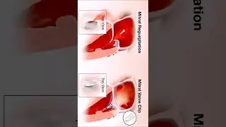 Mitral valve regurgitation -3d animation procedure #shorts #heart #biology