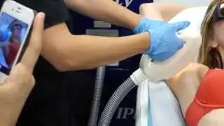 Multi-Wavelength Laser Zaps Away Armpit Hair
