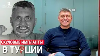 Лечение скуловыми имплантами в Турции 🇹🇷🇹🇷