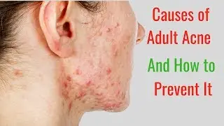 5 Causes of Adult Acne and How to Prevent It
