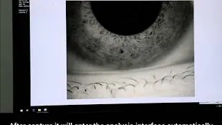 1.Tear Meniscus Height by Kanghua Dry Eye Analyzer Operation Guide