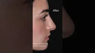 Stunning Rhinoplasty Transformation with Dr. Robert Morin