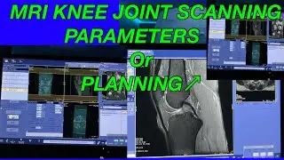 MRI KNEE JOINT SCANNING PARAMETERS or PLANNING #Mri knee joint scan #mri knee joint protocol