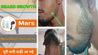 BEARD GROWTH ! Patchy beard - पूरी घनी दाढ़ी आ गई ! Big problem with patchy beard 
