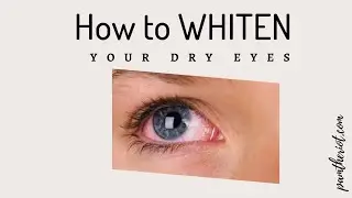 Got dry eyes? Use these tips to reduce their redness.