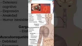 Esclerosis m&uacute;ltiple #hospital #medico #doctor #medstudent #galileomedico #usmlemedicine #usmleprep