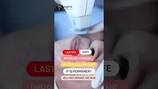 Laser Hair Removal @ Regenix Hair & Skin Clinic #skinclinic #delhi #dermatologist #doctor