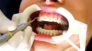 EVELYN GETS BRACES! 😱