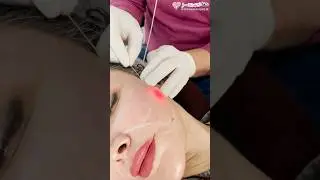 Endo Laser Final Results | Full Face Lift in One Session