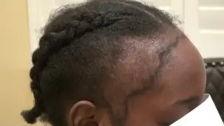 Restoring Edges and Hairline African American Women Black Curly Hair Dr. Diep www.mhtaclinic.com