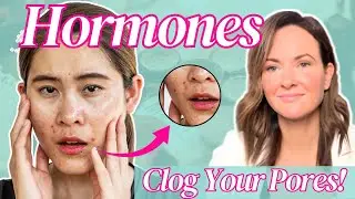 Hormonal Acne in Pregnancy | Safe Treatments for You and Your Baby