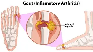 BAD foods for high URIC acid | Foods to AVOID with Gout | Fastest & Natural ways to LOWER Uric Acid.