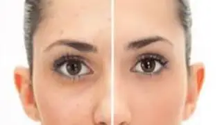 Mole Removal Cream - Effective Mole Removal Techniques