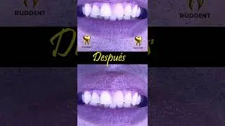 Blanqueamiento interno de diente con necrosis pulpar. La soluci&oacute;n en nuestras manos 🙌🏻. #dental