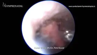 Reziduum po medikovan&eacute; interrupci 7tt gravidity