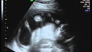 Baby Boy Cidzik 18 weeks