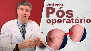 Como &eacute; o p&oacute;s operat&oacute;rio da cirurgia de varizes? (laser e tradicional)