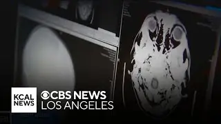 Santa Ana biotech company gets green light from FDA to continue promising new Alzheimer's treatment